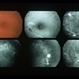 Eales Disease Eales Disease